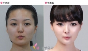 before_and_after_photos_of_korean_plastic_surgery_part_2_640_47.jpg